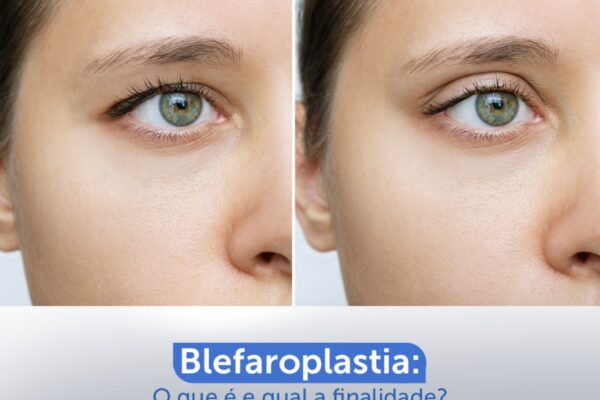 Blefaroplastia: o que é e qual a finalidade