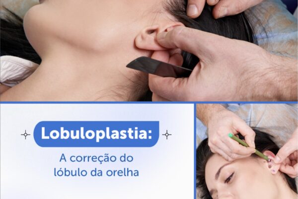 Lobuloplastia: correção do lóbulo da orelha