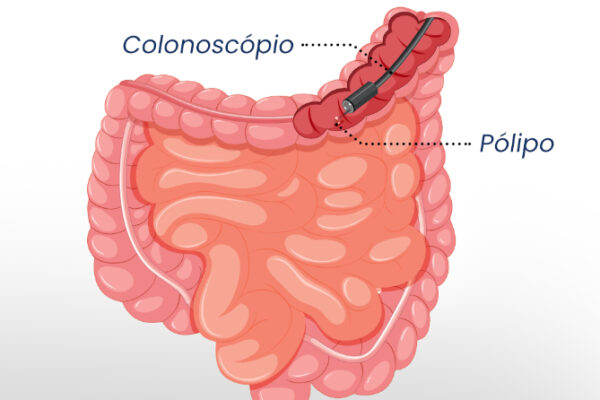 Sobre a colonoscopia